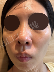 【初回限定】ピコトーニング＋ピコフラクショナル（全顔）の治療結果の症例写真