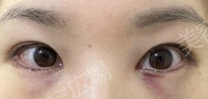 治療直後の症例写真
