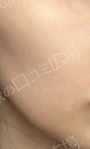 フォトフェイシャルStellar M22の治療結果の症例写真