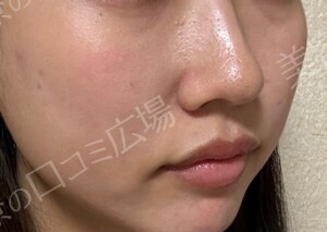治療直後の症例写真