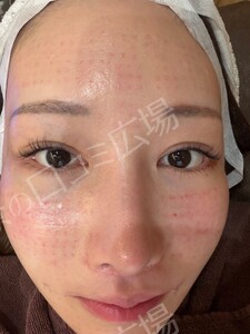 治療直後の症例写真
