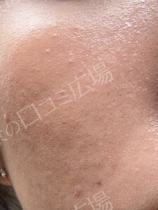 治療直後の症例写真