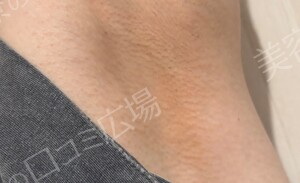 治療直後の症例写真