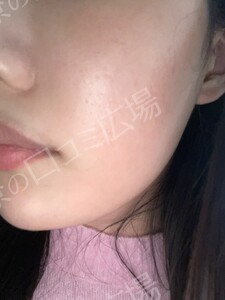治療直後の症例写真