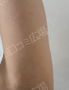 治療直後の症例写真