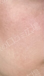 治療直後の症例写真