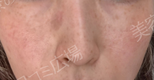 治療結果の症例写真