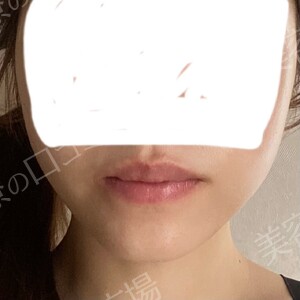 治療直後の症例写真