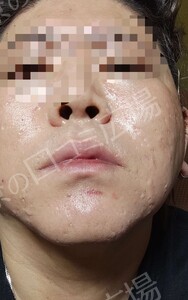 治療直後の症例写真