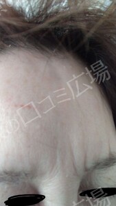 治療直後の症例写真