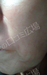 治療直後の症例写真