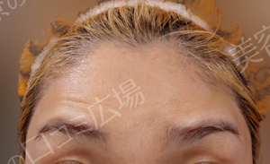 治療直後の症例写真