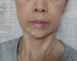 治療直後の症例写真