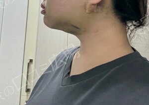 治療直後の症例写真