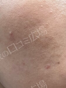治療直後の症例写真