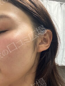 ジェネシスの治療前の症例写真