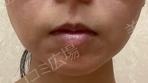 治療直後の症例写真