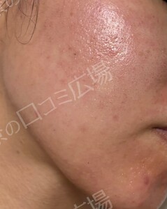 治療直後の症例写真
