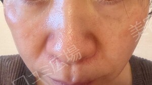 CLINIC Wのしわ・たるみ整形(注入、糸、フェイスリフト)の症例写真[ビフォー]