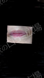 治療直後の症例写真
