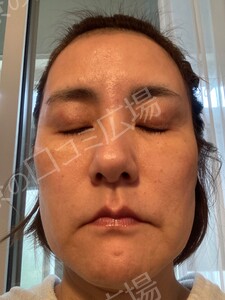 治療前の症例写真