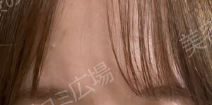 治療直後の症例写真