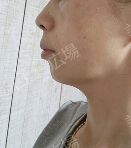 治療直後の症例写真