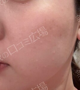 顔脱毛1回｜新宿院：ジェントルマックスプロプラスの治療直後の症例写真