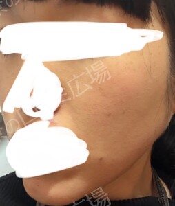 治療結果の症例写真