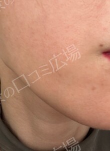 治療直後の症例写真