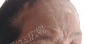 治療直後の症例写真