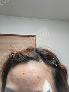 治療直後の症例写真
