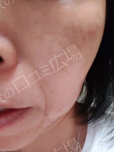 治療直後の症例写真