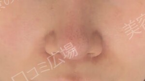 ハイドラジェントル｜毛穴の黒ずみを集中的に除去の治療直後の症例写真