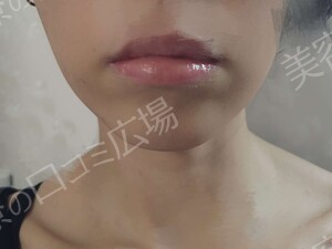 治療直後の症例写真