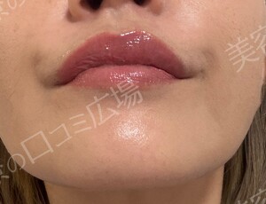 ルラ（LULA）美容クリニック 福岡天神院の症例写真[アフター]