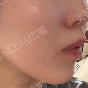 ピコレーザーピコレーザートーニングの治療前の症例写真