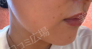 【高崎院限定】初回限定：無料✨｜ピコトーニング｜全顔1回の治療直後の症例写真