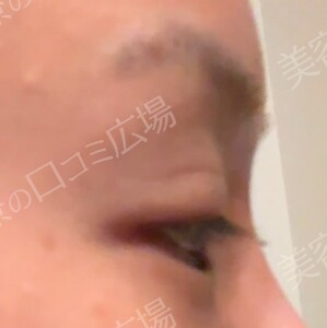 治療直後の症例写真