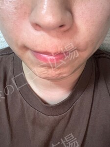 治療直後の症例写真