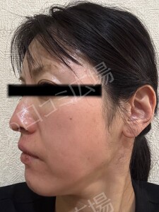 治療直後の症例写真