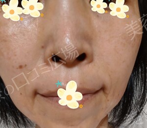 治療前の症例写真