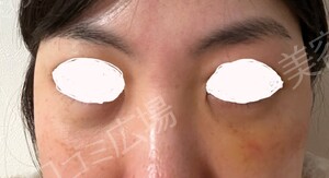 治療直後の症例写真