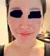 施術前の状態