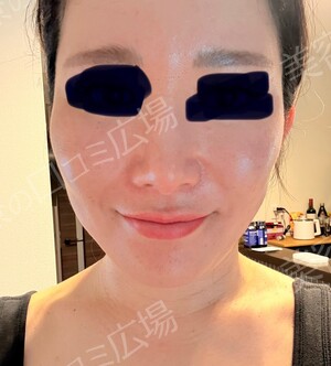 医療法人秀晄会 心斎橋コムロ美容外科クリニックの傷跡治療、ケロイドの症例写真[ビフォー]