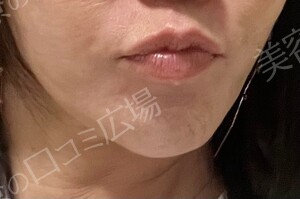 治療直後の症例写真