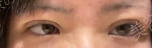 植村美容外科_埋没法（埋没法(5年保証)3点とめ）の治療直後の症例写真
