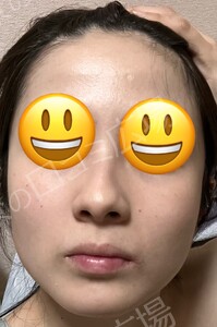 治療直後の症例写真