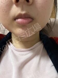 治療直後の症例写真