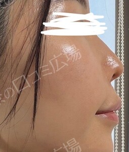 治療直後の症例写真